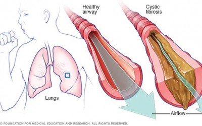 Senate, Assembly Unanimously Approve Adult Cystic Fibrosis Assistance Program Bill