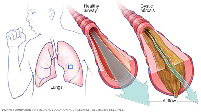 Senate, Assembly Unanimously Approve Adult Cystic Fibrosis Assistance Program Bill